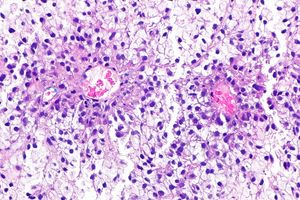 HE 염색을 실시한 신세포암종 조직. 로제트 모양 구조가 보인다.