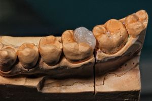 자연 치아에 접착될 IPS emax 세라믹으로 모델에 제작된 간접 수복물