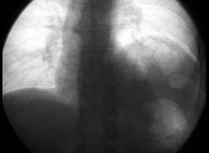 X선 투시법으로 본 왼가로막신경의 마비 (영상의 오른쪽). 입을 닫은 채 강제로 들숨을 할 시 마비된 왼쪽 가로막이 정상과 정반대로 올라오며, 정상적인 오른쪽 가로막은 밑으로 움직이고 있다.