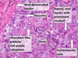 절제된 종양의 조직병리학은 전형적인 특징으로 진단을 확인해준다.