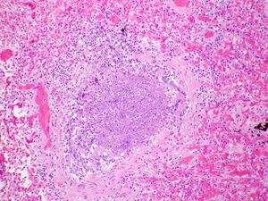조직학 슬라이드 - 기관지세관의 루멘을 막는 급성 염증 삼출물과 기관지세관 벽 일부의 급성 염증. 이는 모세기관지염에 걸린 아이의 기관지세관에서 발생하는 염증을 세포 수준에서 보여준다.