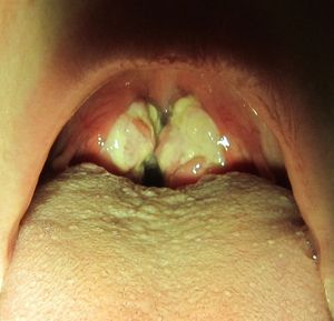 전염성 단핵구증