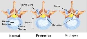 척추 디스크 탈출의 단계