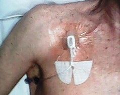 포트에 삽입된 그리퍼 바늘