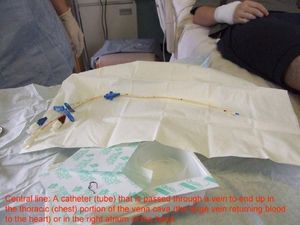 가장 흔하게 삽입되는 중심 정맥관은 7프렌치 삼중 루멘 카테터이다.