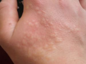 쐐기풀 피부염이 있는 손