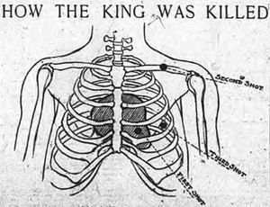 사람의 왼쪽 측면에 세 군데의 충격 지점이 있는 늑골 그림