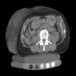 3D 모델을 형성하기 위해 쌓아 올린 여러 장의 컴퓨터 단층 촬영술(QCT) X선 이미지