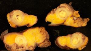 충수 카르시노이드 종양