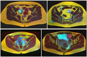 MRI 상의 4가지 종류의 난소 낭종