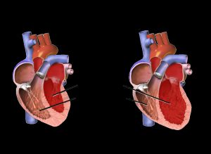 정상 심장과 확장성 심근병증이 있는 심장의 그림