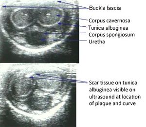 페이로니병 환자의 음경 초음파 사진. 윗쪽 이미지는 정상적인 해부학적 구조를 보여주지만, 아래쪽 이미지는 백막(음경)에 흉터 조직을 보여준다. 흉터 조직은 국소화되어 있으며 페이로니병의 특징적인 변형(만곡 및 협착)을 유발한다.