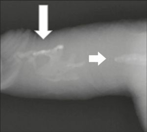 투사 방사선 촬영(X-ray). 음경의 연조직을 관통하여 해면체에서 석회화에 해당하는 방사선 불투과성 영상이 관찰된다(화살표).