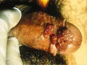 남성의 생식기 사마귀가 심한 경우