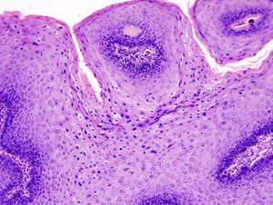생식기 사마귀의 현미경 사진. 특징적인 변화(과각화증, 공포세포, 유두종증)를 보여준다. H&E 염색.