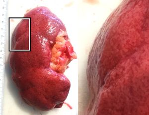 육안 병리학에서 신경화증은 미세 과립 표면으로 나타난다.