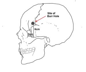 프리먼과 와츠가 개발한 표준 전두엽 절제술/백질 절개술 수술을 위한 천공 위치