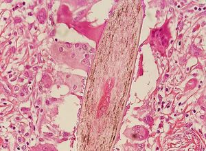 원인 불명의 모낭염의 조직병리학, 거대 세포가 모발 모낭을 둘러싸고 있다.