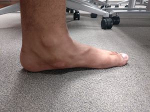 임상적 연조직 부종이 있는 후천성 평발 변형