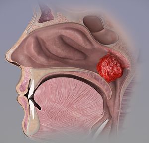 3D 그림으로 아데노이드 비대증을 보여줌