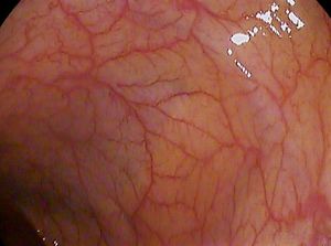 대장내시경 사진, 비장 굴곡부,정상 점막. 그 안으로 비장을 볼 수 있다