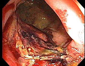 대장내시경에서 방사선 직장염을 보여주는 모습