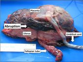 자궁을 열어 태반 조기 박리를 보여주는 거시 병리, 자궁에서 태반을 분리하는 혈종.