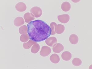 급성 전골수성 백혈병에서 전골수구의 축적