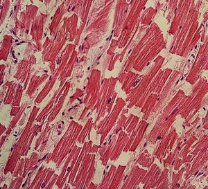 파열된 사이원반(끼임원반), 이 경우 시각적 인공물로 간주된다.