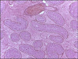 출혈성 경색을 보여주는 고환의 현미경 사진. H&E 염색.