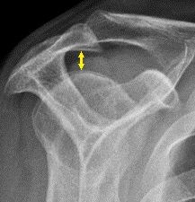 Supraspinatus outlet view X-ray, showing subacromial space measurement