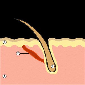 1) 표피 2) 입모근 3) 털집 4) 진피. 이 그림은 입모근이 털집과 표피에 연결되어 근육 수축 시 털을 세워 닭살을 유발하는 것을 보여준다.