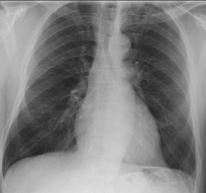 다발혈관염 동반 육아종증 사례에서 왼쪽 폐첨부가 불투명해짐
