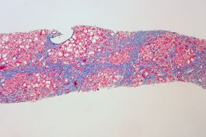 알코올성 간경변증에 걸린 간의 현미경 사진. 트리크롬 염색으로 섬유 조직을 파랗게 염색했다. 이 역시 간세포가 섬유 조직에 의해 조여져 있다. 또한 과도한 음주자에게서 흔히 볼 수 있는 지방간 소견인 지방공포(빨갛게 보이는 간세포 안에 보이는 둥글고 하얀 빈 공간)도 보인다.