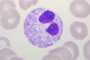 펠거-휘트 핵 이상: 코안경 모양의 핵