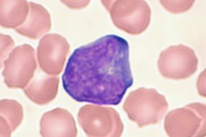 이형 림프구. 핵은 분엽상