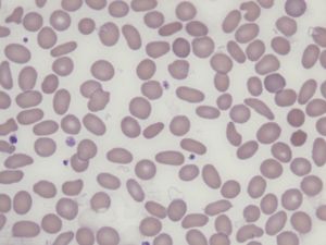 유전성 타원 적혈구증