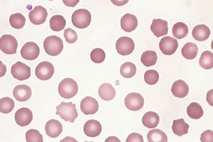 구상 적혈구: 중앙의 창백한 부분이 소실됨