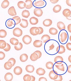 파쇄 적혈구(TTP)