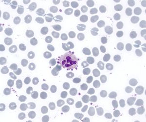 혈소판 위성 현상. 백혈구 주위에 혈소판이 부착되어 있다.