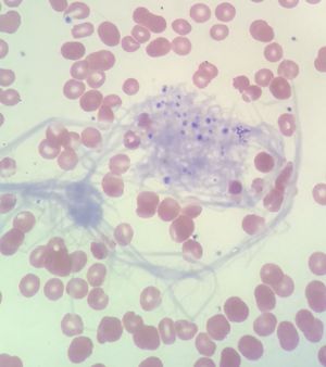 검체 응고로 인해 혈소판과 피브린 덩어리가 보인다.