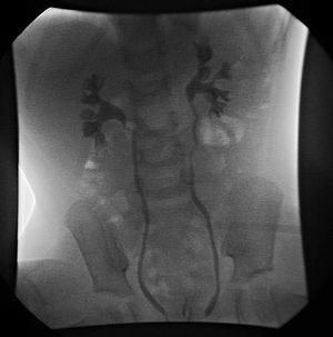 양측 2등급(비확장) 방광요관역류를 보여주는 VCUG