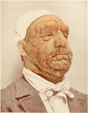 머리와 목에서 보이는 종양 단계의 균상식육종