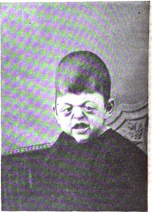 Acrocephalosyndactyly type 1에서의 안구돌출증