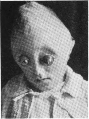 클로버 잎 두개골에서의 안구돌출증