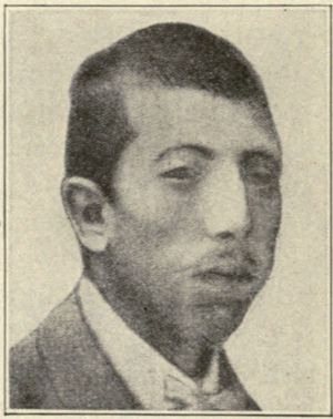 소두증(두개탑)에서의 안구돌출증