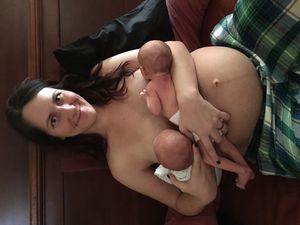 출산 6일 후 쌍둥이에게 젖을 먹이는 여성. 임신 흑선이 여전히 보인다.