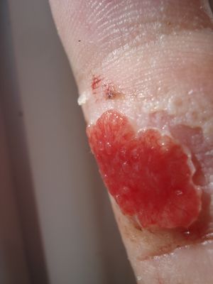 살이 차오르는 것과 같은 "과립 조직"으로 손가락이 베인 상처의 예