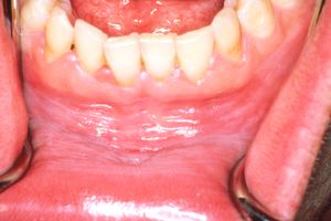 아래 입술고랑의 백색판증