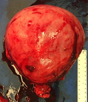 완전 수포성 포상기태를 가진 자궁